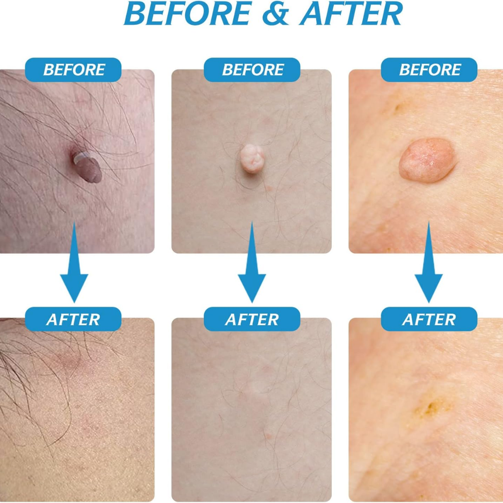 SmoothAway Skin Tag Remover Kit