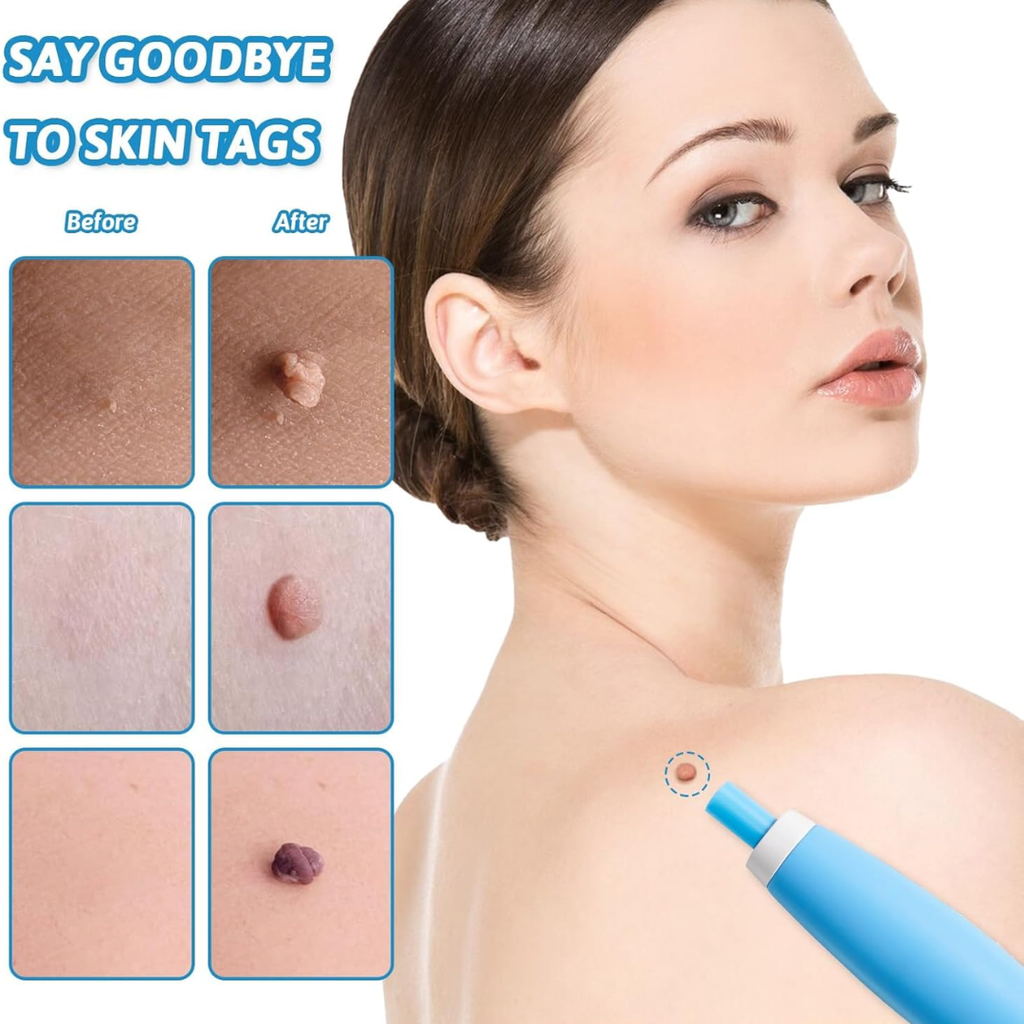 SmoothAway Skin Tag Remover Kit