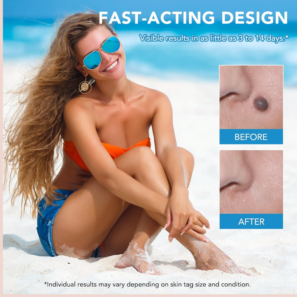 SmoothAway Skin Tag Remover Kit