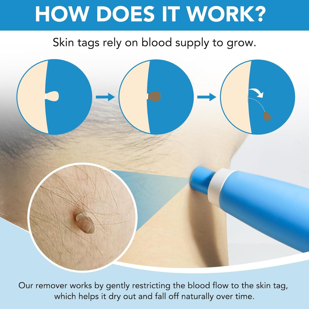 SmoothAway Skin Tag Remover Kit