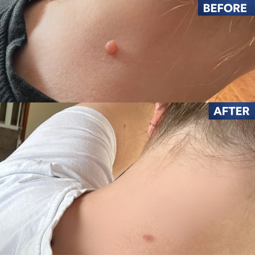 Skin Tag Corrector Kit